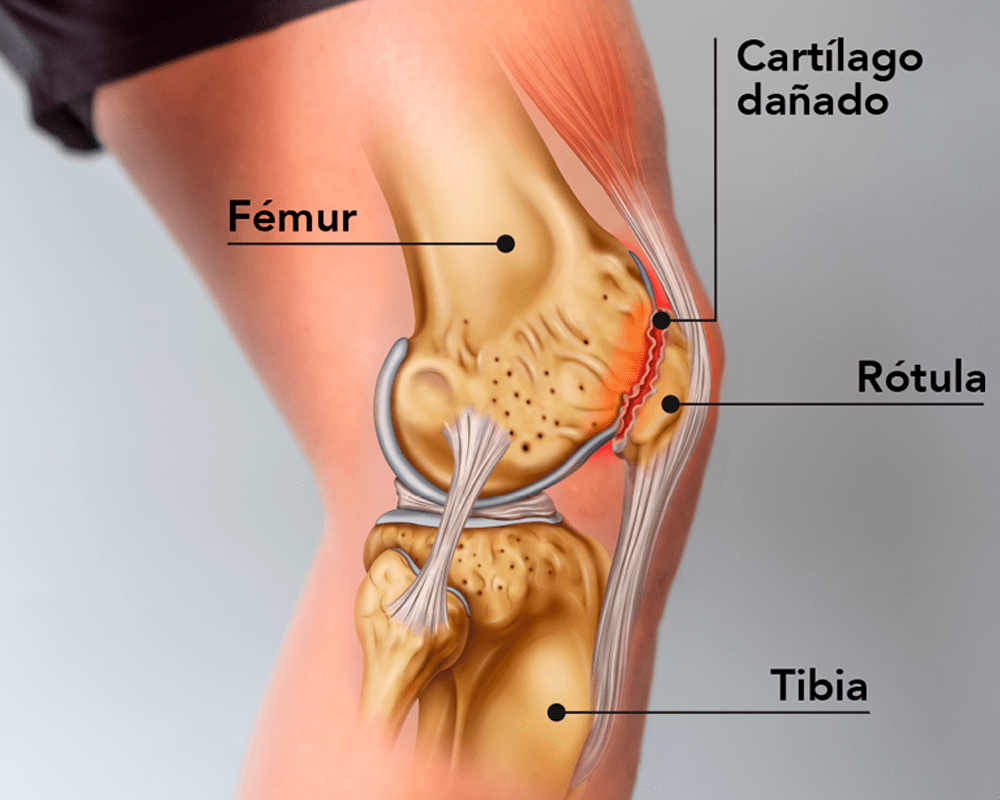 Infografia-condromalacia-rotuliana-sevilla